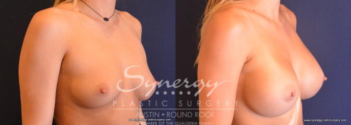 Before & After Breast Augmentation Case 671 View #5 View in Austin, TX