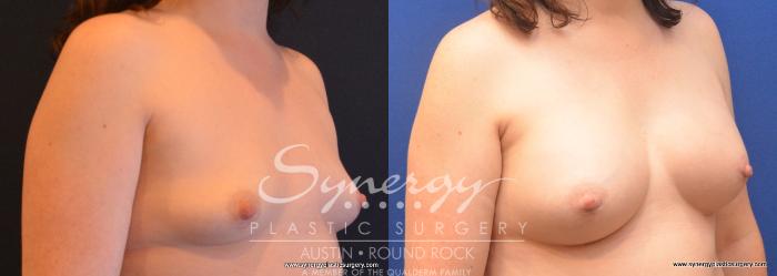 Before & After Breast Augmentation Case 672 View #2 View in Austin, TX
