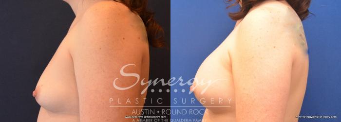 Before & After Breast Augmentation Case 672 View #3 View in Austin, TX
