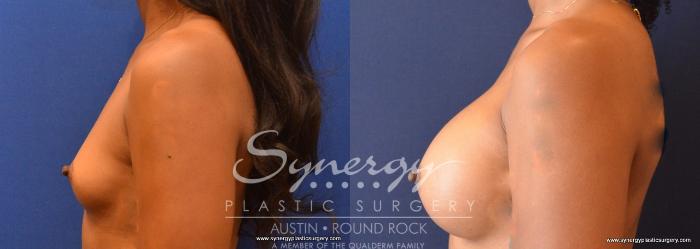 Before & After Breast Augmentation Case 674 View #1 View in Austin, TX