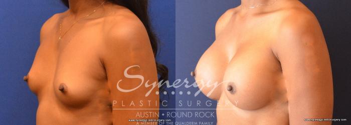 Before & After Breast Augmentation Case 674 View #2 View in Austin, TX