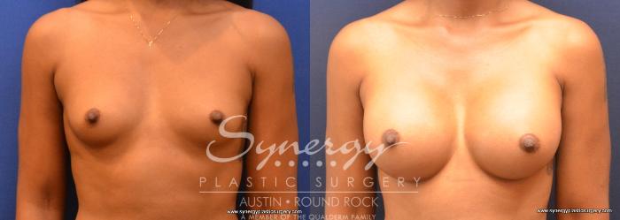 Before & After Breast Augmentation Case 674 View #3 View in Austin, TX