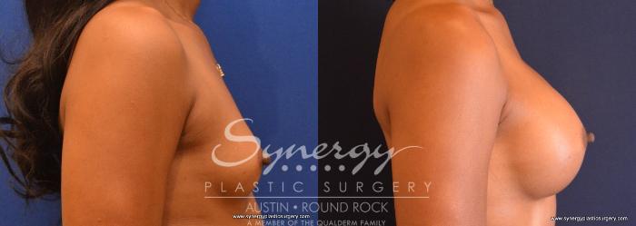 Before & After Breast Augmentation Case 674 View #4 View in Austin, TX