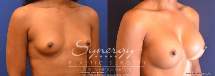 Before & After Breast Augmentation Case 674 View #5 View in Austin, TX