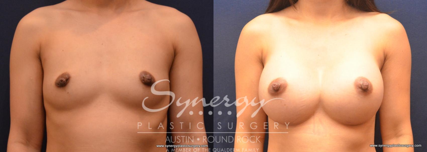 Before & After Breast Augmentation Case 675 View #1 View in Austin, TX