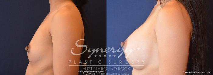 Before & After Breast Augmentation Case 675 View #3 View in Austin, TX