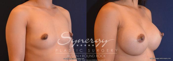 Before & After Breast Augmentation Case 675 View #4 View in Austin, TX
