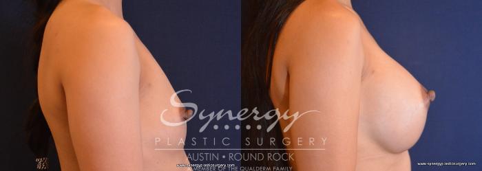 Before & After Breast Augmentation Case 675 View #5 View in Austin, TX