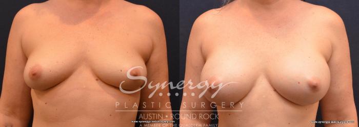 Before & After Breast Augmentation Case 676 View #2 View in Austin, TX