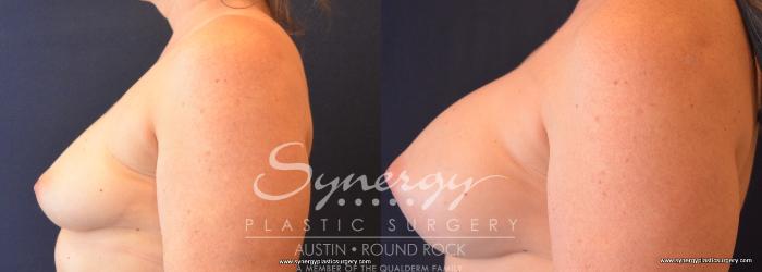Before & After Breast Augmentation Case 676 View #3 View in Austin, TX