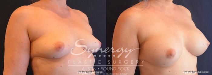 Before & After Breast Augmentation Case 676 View #4 View in Austin, TX