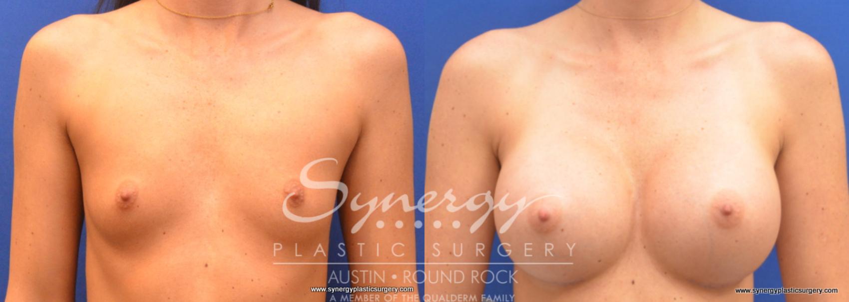 Before & After Breast Augmentation Case 677 View #1 View in Round Rock, TX