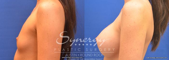 Before & After Breast Augmentation Case 677 View #2 View in Austin, TX