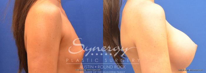 Before & After Breast Augmentation Case 677 View #3 View in Austin, TX