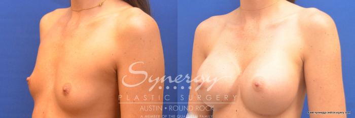 Before & After Breast Augmentation Case 677 View #4 View in Austin, TX