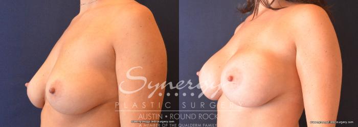 Before & After Breast Augmentation Case 681 View #2 View in Austin, TX
