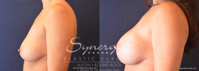 Before & After Breast Augmentation Case 681 View #3 View in Austin, TX