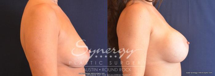 Before & After Breast Augmentation Case 681 View #4 View in Austin, TX
