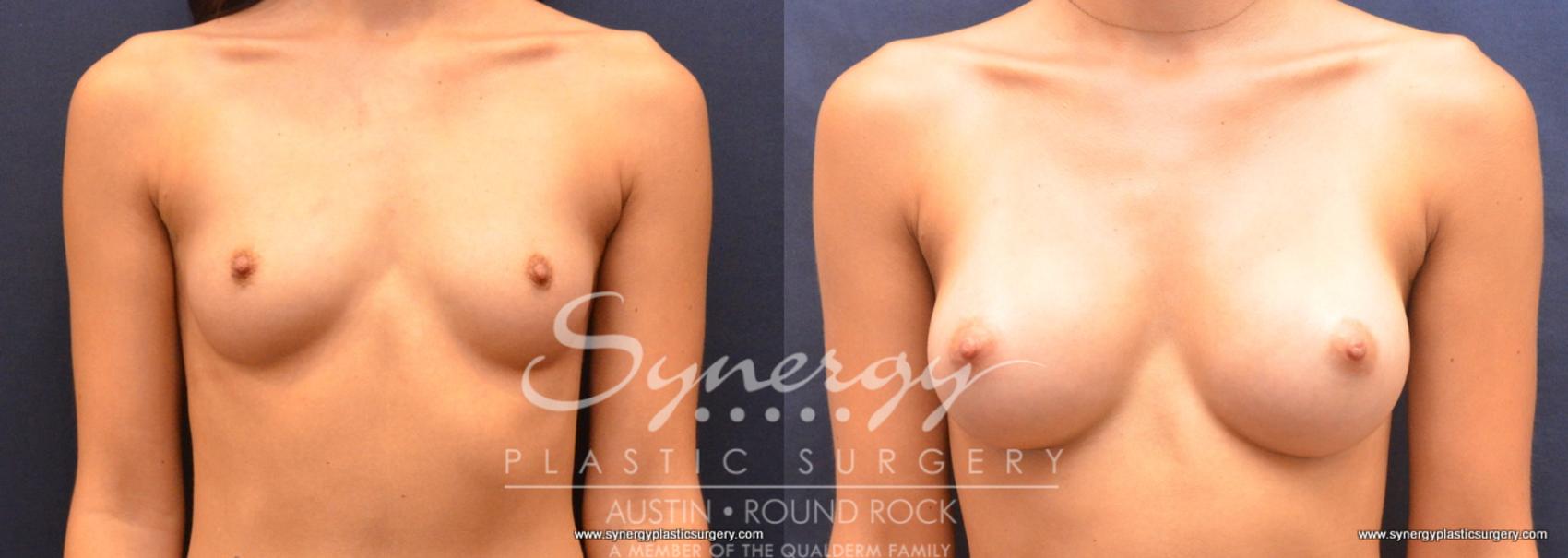 Before & After Breast Augmentation Case 684 View #1 View in Austin, TX