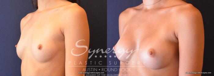 Before & After Breast Augmentation Case 684 View #2 View in Austin, TX