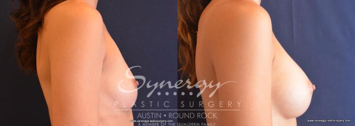 Before & After Breast Augmentation Case 684 View #3 View in Austin, TX