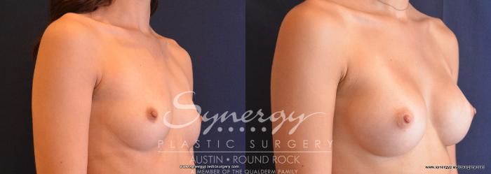 Before & After Breast Augmentation Case 684 View #4 View in Austin, TX