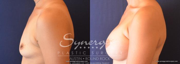 Before & After Breast Augmentation Case 685 View #2 View in Austin, TX