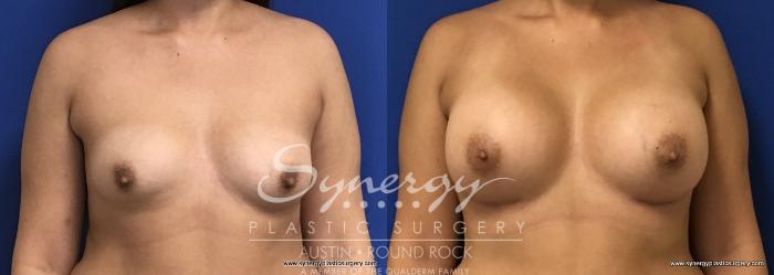 Before & After Breast Augmentation Case 686 View #1 View in Austin, TX