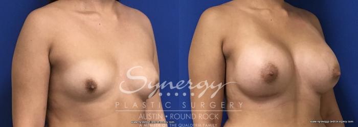 Before & After Breast Augmentation Case 686 View #2 View in Austin, TX