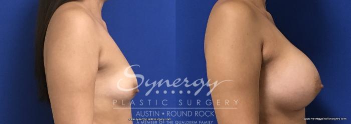 Before & After Breast Augmentation Case 686 View #3 View in Austin, TX