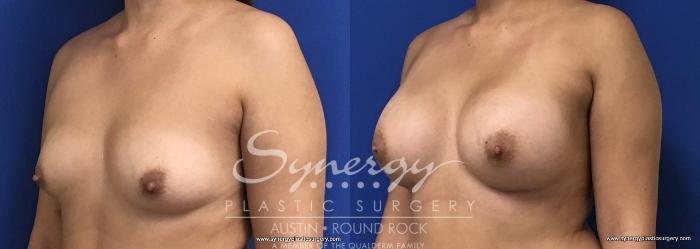 Before & After Breast Augmentation Case 686 View #4 View in Austin, TX
