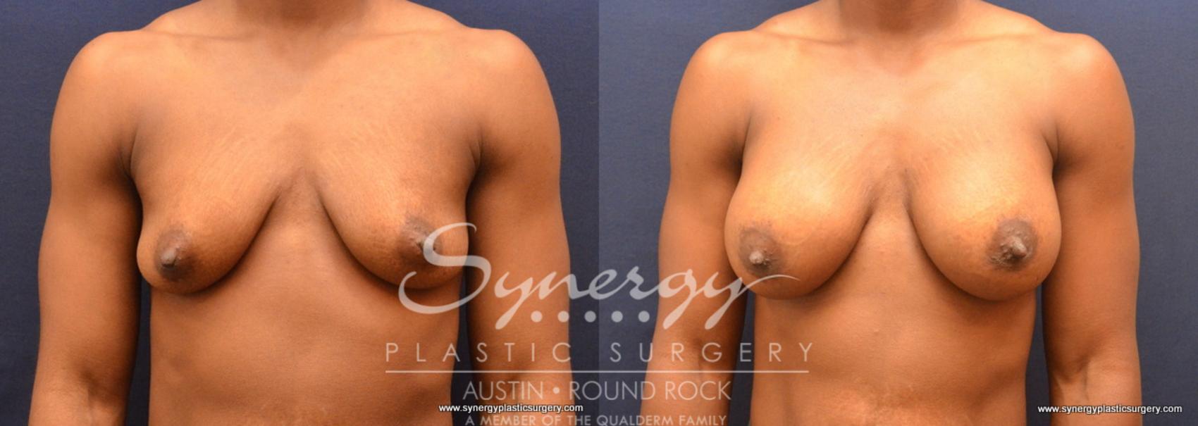 Before & After Breast Augmentation Case 689 View #1 View in Austin, TX