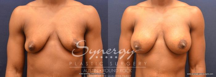 Before & After Breast Augmentation Case 689 View #1 View in Austin, TX