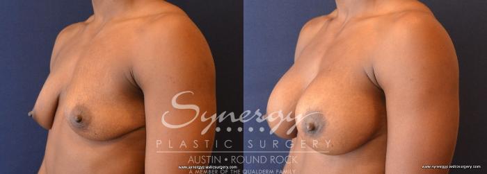 Before & After Breast Augmentation Case 689 View #2 View in Austin, TX