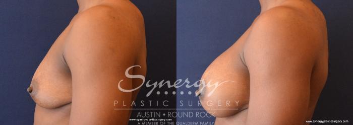 Before & After Breast Augmentation Case 689 View #3 View in Austin, TX
