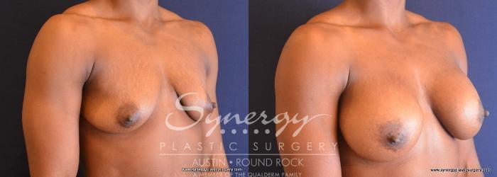 Before & After Breast Augmentation Case 689 View #4 View in Austin, TX