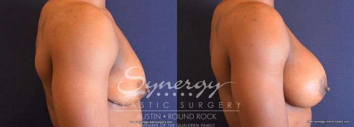 Before & After Breast Augmentation Case 689 View #5 View in Austin, TX