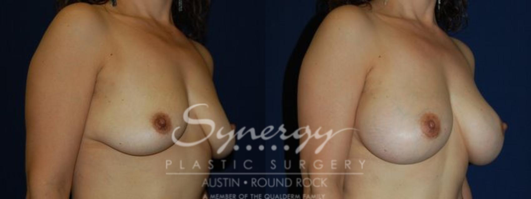 Before & After Breast Augmentation Case 69 View #1 View in Austin, TX