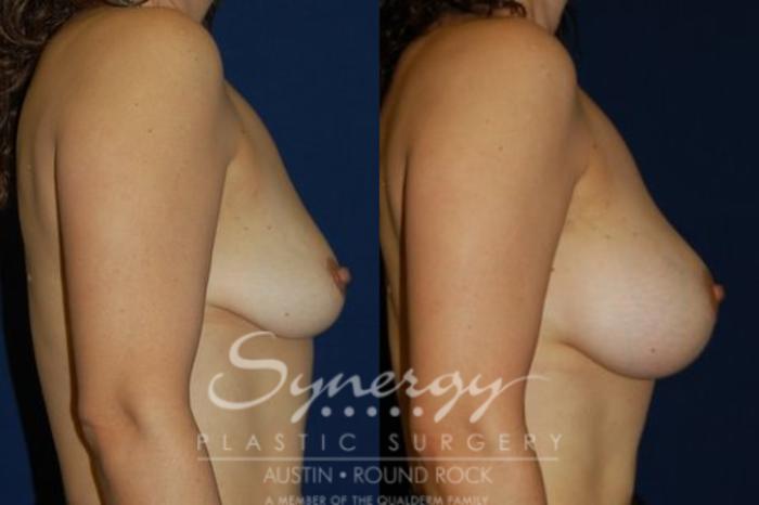 Before & After Breast Augmentation Case 69 View #2 View in Austin, TX