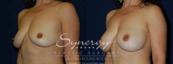 Before & After Breast Augmentation Case 69 View #4 View in Austin, TX