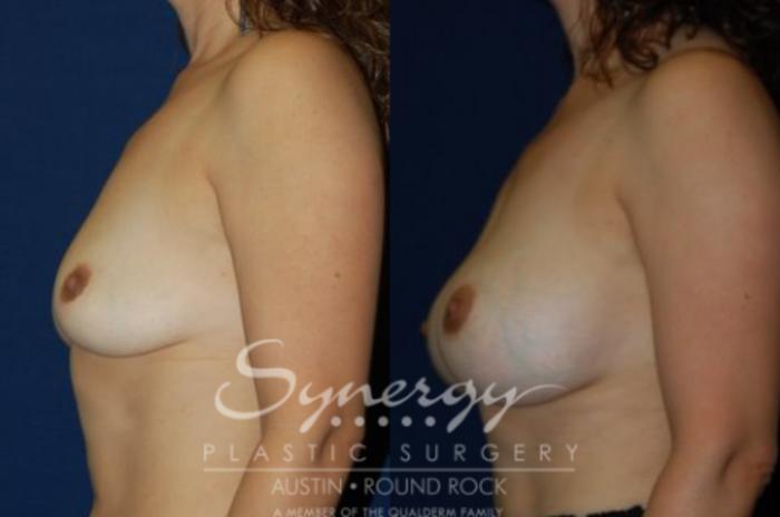 Before & After Breast Augmentation Case 69 View #5 View in Austin, TX