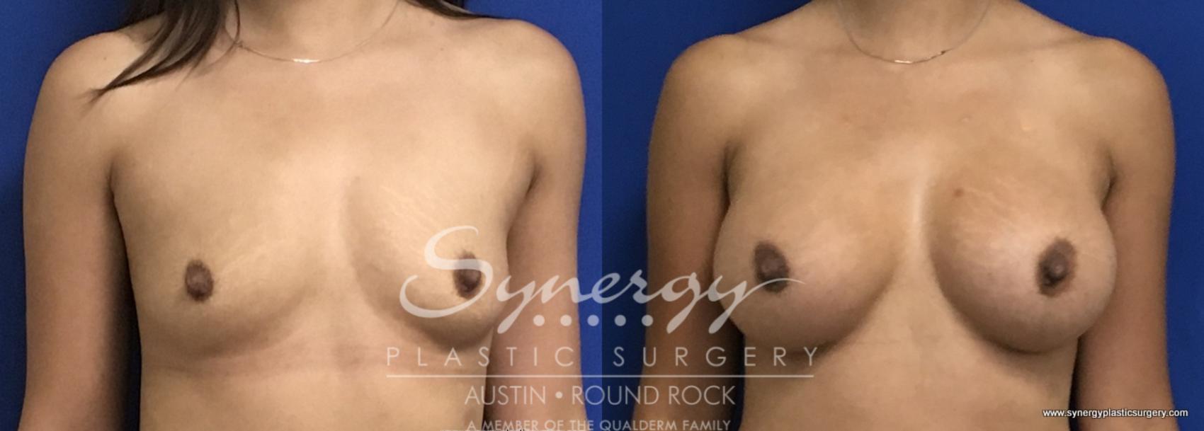 Before & After Breast Augmentation Case 695 View #1 View in Austin, TX