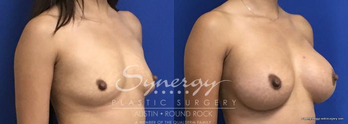 Before & After Breast Augmentation Case 695 View #2 View in Austin, TX