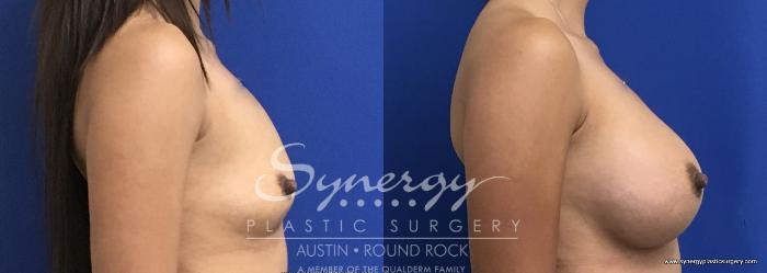 Before & After Breast Augmentation Case 695 View #3 View in Austin, TX