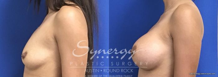 Before & After Breast Augmentation Case 695 View #4 View in Austin, TX