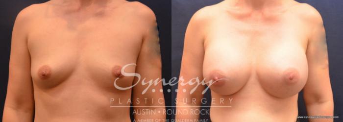 Before & After Breast Augmentation Case 696 View #1 View in Austin, TX