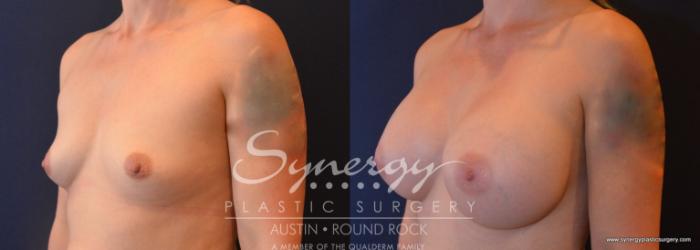 Before & After Breast Augmentation Case 696 View #2 View in Austin, TX
