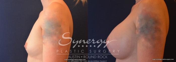 Before & After Breast Augmentation Case 696 View #3 View in Austin, TX