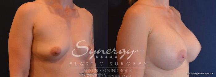 Before & After Breast Augmentation Case 696 View #4 View in Austin, TX