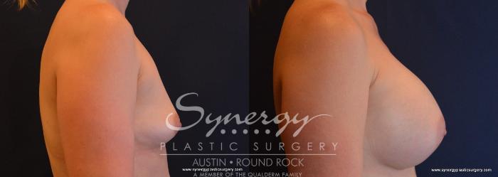 Before & After Breast Augmentation Case 696 View #5 View in Austin, TX